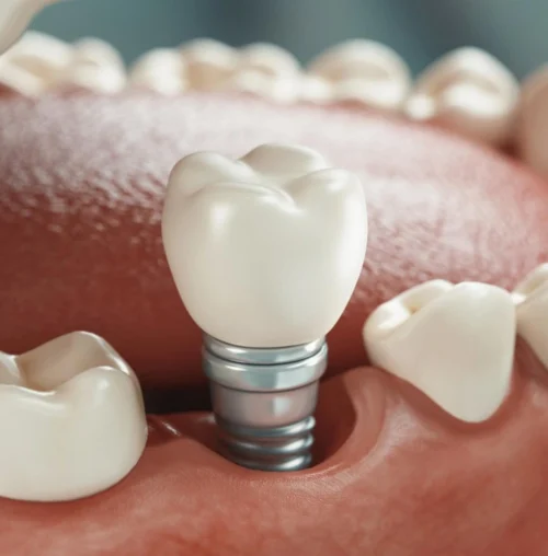 Dental-Implants