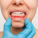 Gum-Inflammation