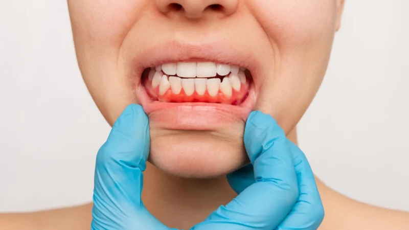 Gum-Inflammation
