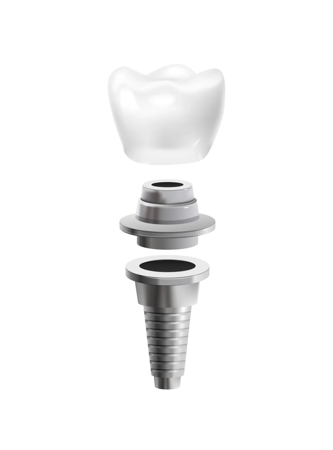 Metal-Dental-Implant