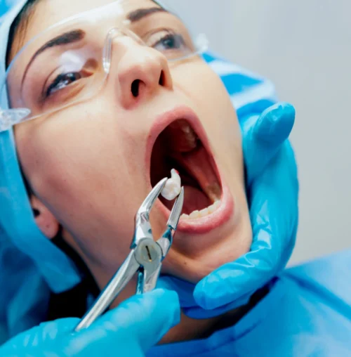 Tooth-Extraction-new
