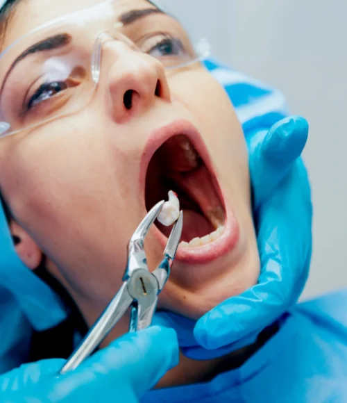 Tooth-Extraction-new