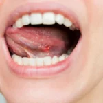 Mouth-Cancer