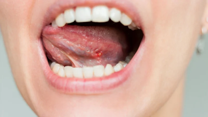 Mouth-Cancer