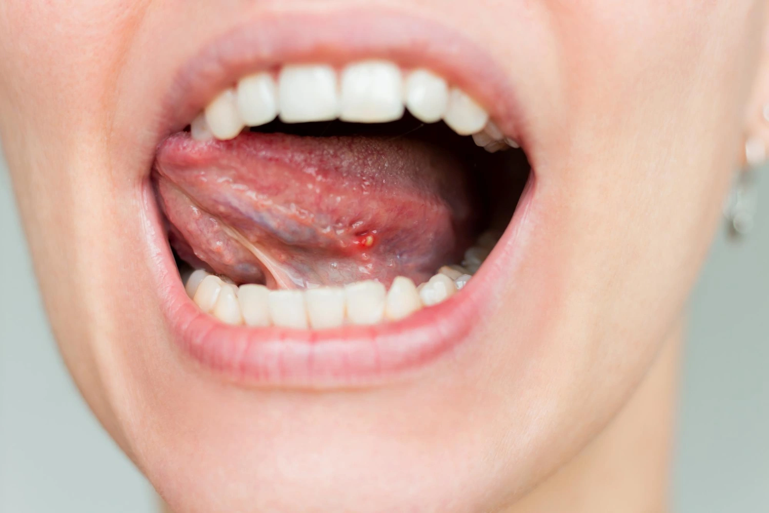 Mouth-Cancer