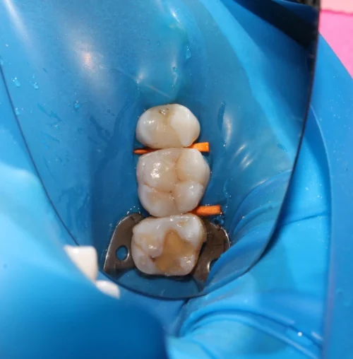 Dental-Sealants