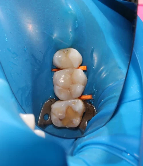 Dental-Sealants