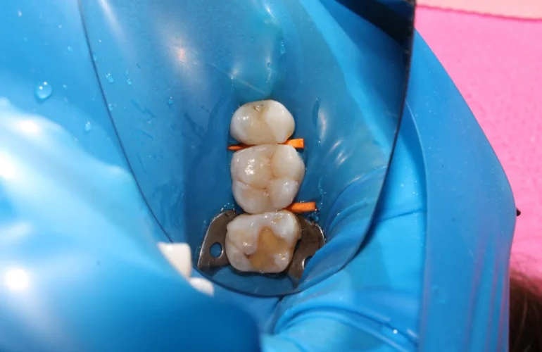 Dental-Sealants