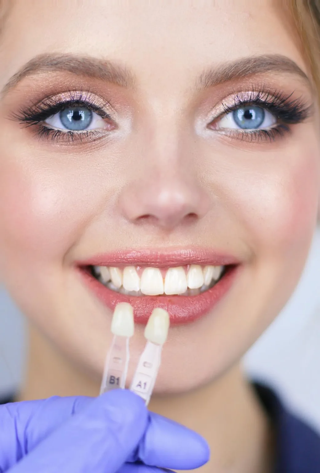 Porcelain-Veneers-02