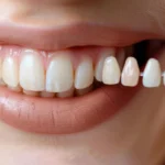 Porcelain-Veneers